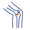 theknee-Torn-Knee-Meniscus